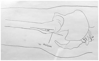 Perioperative safety assessment of patients undergoing unilateral or bilateral hip replacements